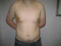 male breast reduction Liverpool