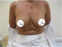 Liverpool breast augmentation mastopexy