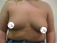 Liverpool augmentation mastopexy breast