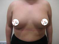 breast augmentation mastopexy Liverpool