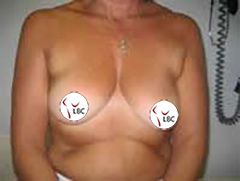 Liverpool breast asymmetry