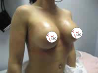 breastenlargement_a1_2
