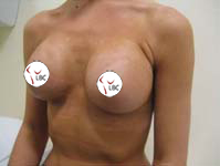 breastenlargement_c1_2