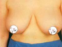 Liverpool breast reduction
