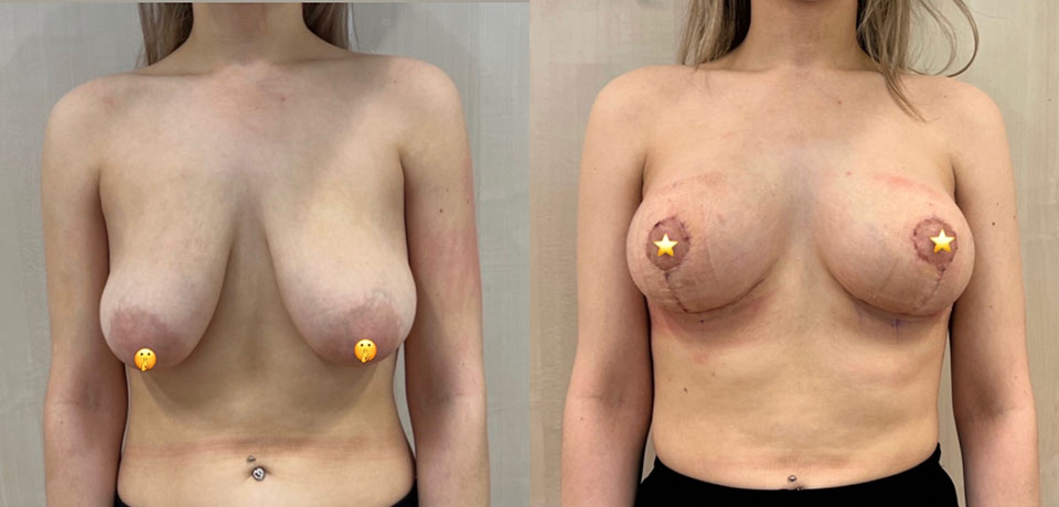 Mastopexy breast uplift results