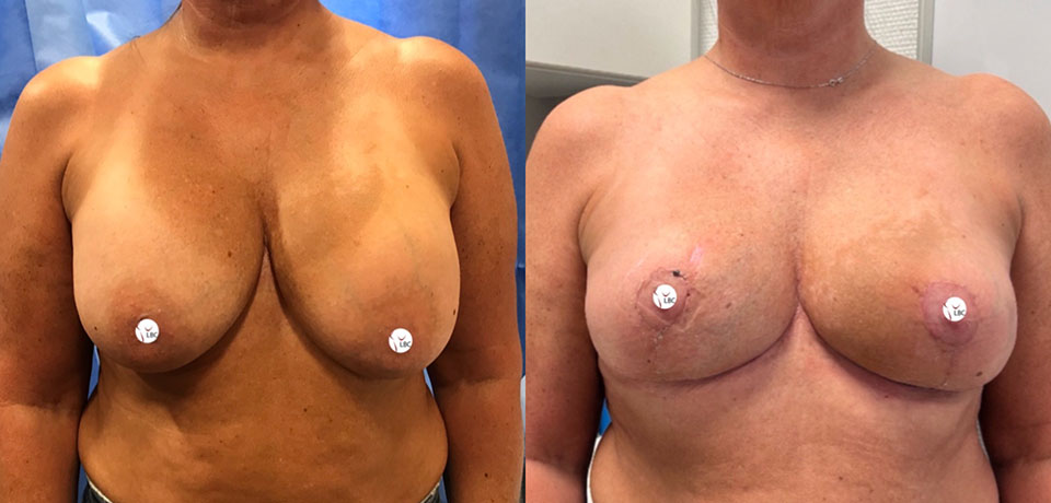 Removal of implants and uplift
