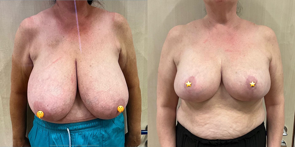 Breast reduction