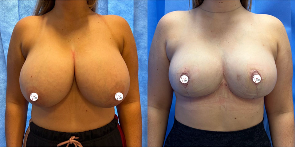 Breast reduction